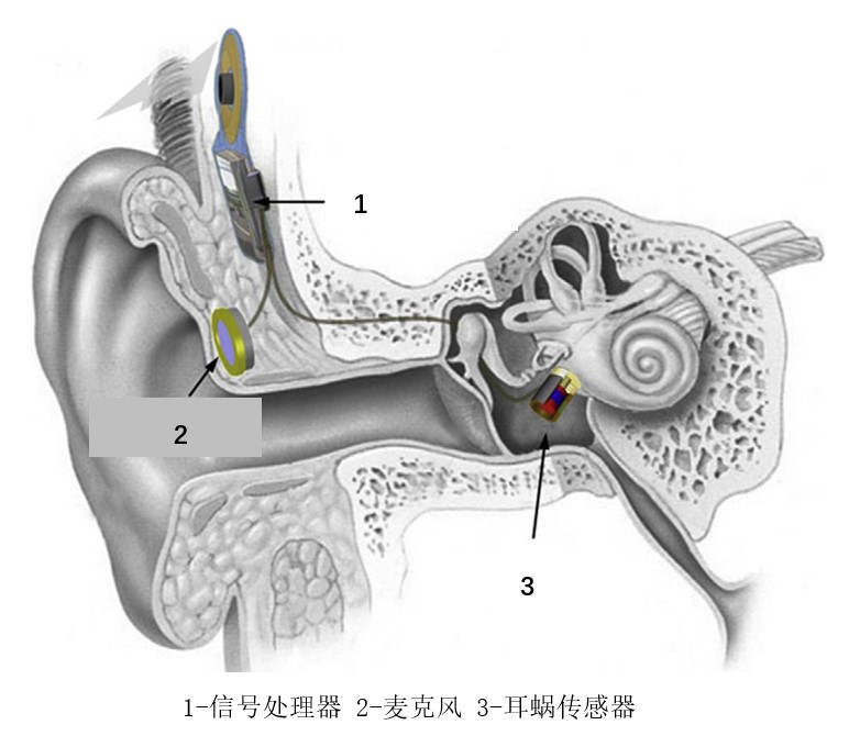 金属波纹管助听器原理示意图